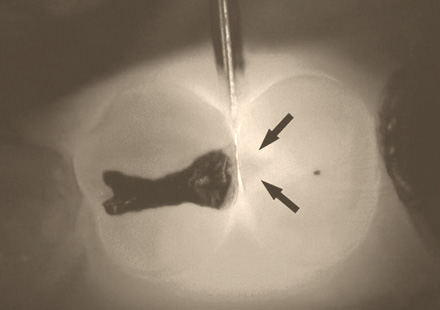 Zahnkaries_Diagnose_06